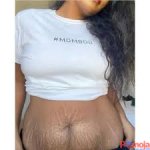 Jinsi ya Kuondoa michirizi kwenye ngozi kwa njia za Asili zisizo na Madhara.jpeg